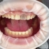 大家口中的“变色牙”很大部分是死髓变色导致