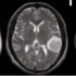 脑出血及脑梗塞影像学表现对比分析。