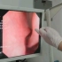 耳鼻喉见习-电子鼻咽镜检查