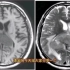 颅内典型病例MRI表现分享，抓住典型征象，诊断很容易！