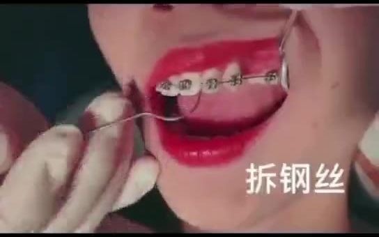 传统金属牙齿矫治器哔哩哔哩bilibili