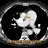 影像知识科普：肺动脉解剖讲解，肺动脉高压在CT上什么表现？