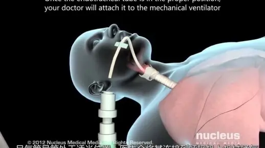 《气管插管、机械通气》