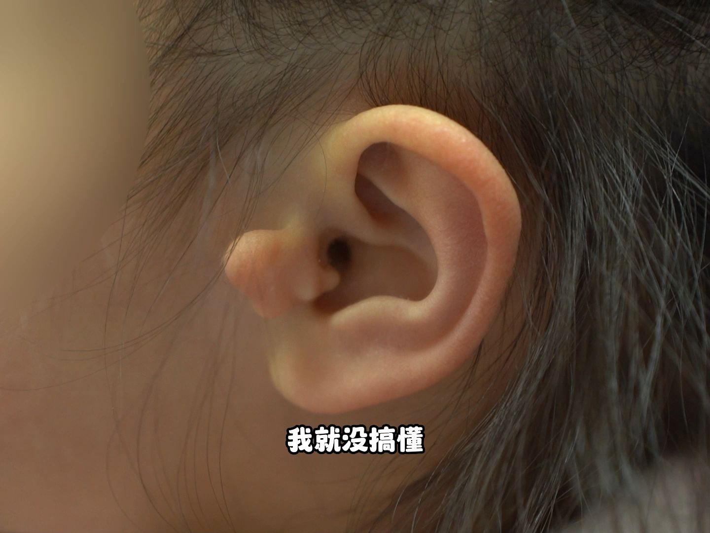 妈妈怀疑甲醛造成的孩子附耳，医生:把它利用起来做耳屏。