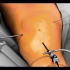 肩关节肩袖损伤手术修复过程，3D演示。。