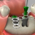 爱牙网：种植牙，牙骨萎缩时，加骨粉的4种方法