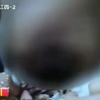 女子做隆胸手术，没想到手术失败胸部淤血腐烂，美梦成了噩梦