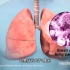 肺癌的发生过程，3D演示。。