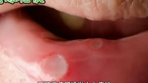 口腔溃疡不重视，带来的疾病竟是这些大魔王