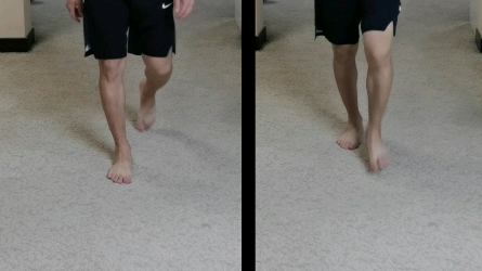 【线下矫正案例】O型腿步态模式矫正，大家看出差别了吗，走路方式对了腿型才能矫正好，否则肯定还会反弹。 