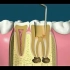 根管治疗（杀神经）动画演示，牙髓炎患者必经之路（中文字幕）