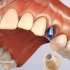 沧州莱恩口腔，种植牙过程