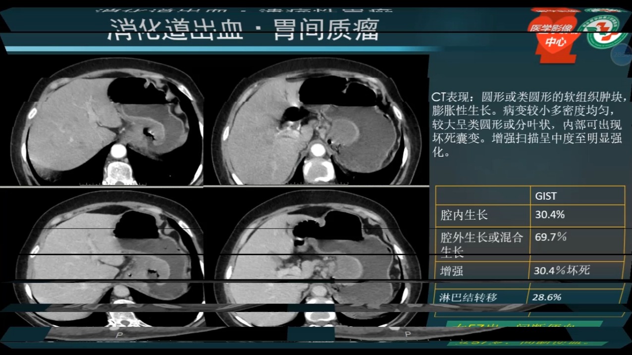 第十一讲 消化道出血01（共30讲）