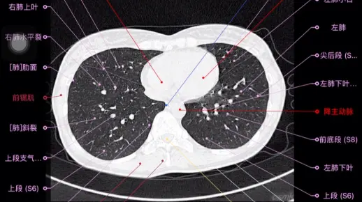拼手速收藏！肺部薄扫CT（肺窗有注释版）
