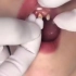 实拍美女种牙过程！