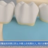 牙周手术治疗（牙周再生治疗）