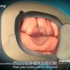 脑瘤切除术手术过程，3D演示。。
