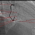 8.心血管影像解剖图谱-冠状动脉造影DSA常规命名法-右冠状动脉解剖