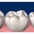 牙釉质缺了一块老是刮舌头，怎么办呢？一起来看看！「大连齿医生口腔修复中心」「大连口腔医院」