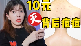 背后有痘怎么办 b3c5acb08fb6d0c9aa23f9003f20dd98b119f341.jpg@280w_158h_1c_100q.jpg