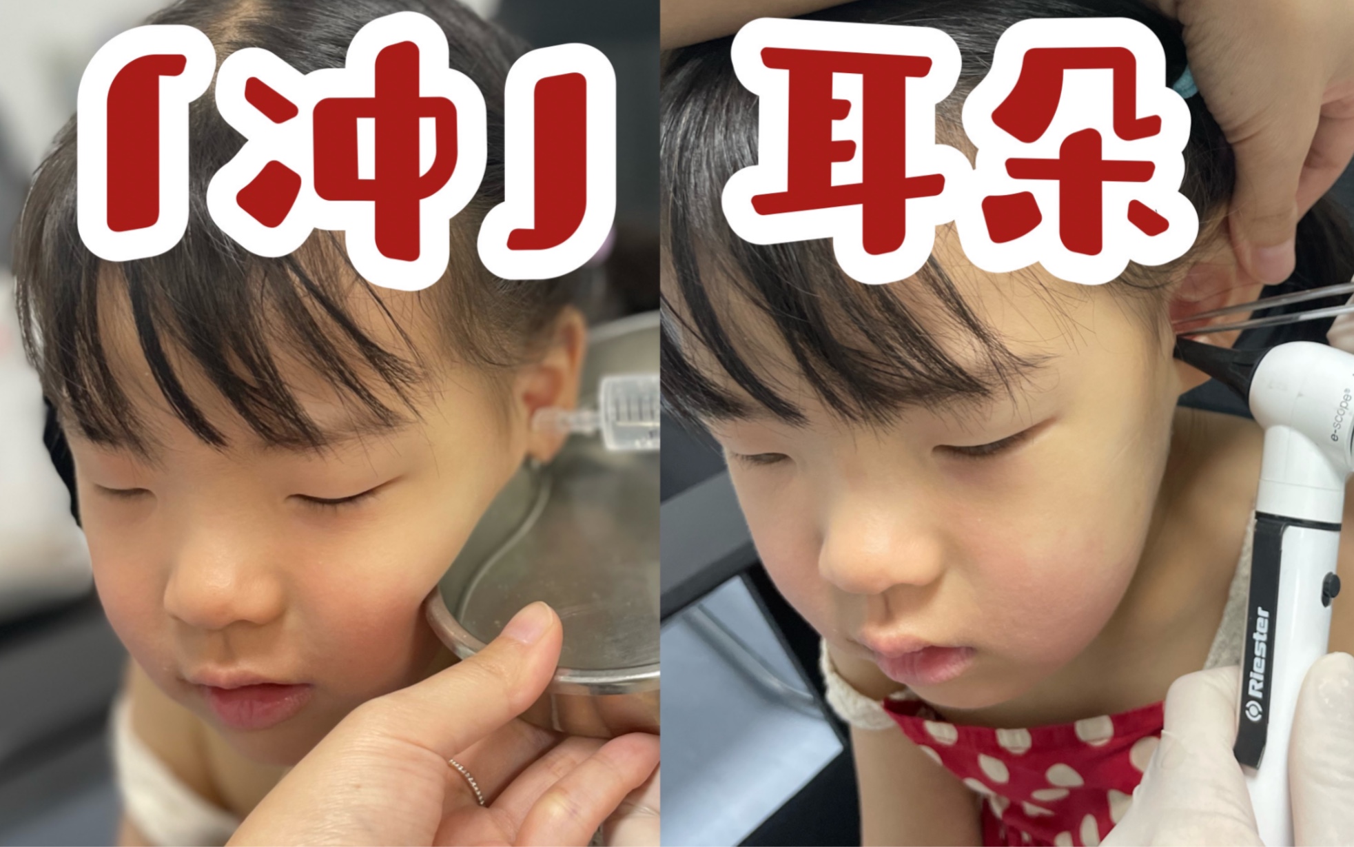 4岁娃耳屎塞满了耳朵👂第一次体验在医院「冲耳朵」