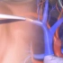 3D医学动画：《CVC和PICC简单介绍》