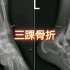 21.三踝骨折—读片系列-骨肌系统