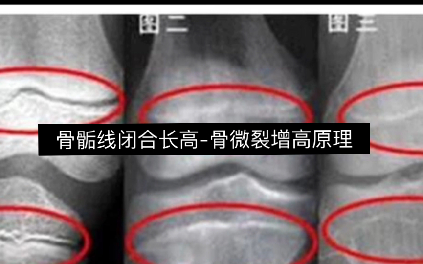 骨骺线闭合长高-骨微裂增高原理