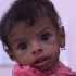 也门大量儿童营养不良，3岁小孩仅重5公斤