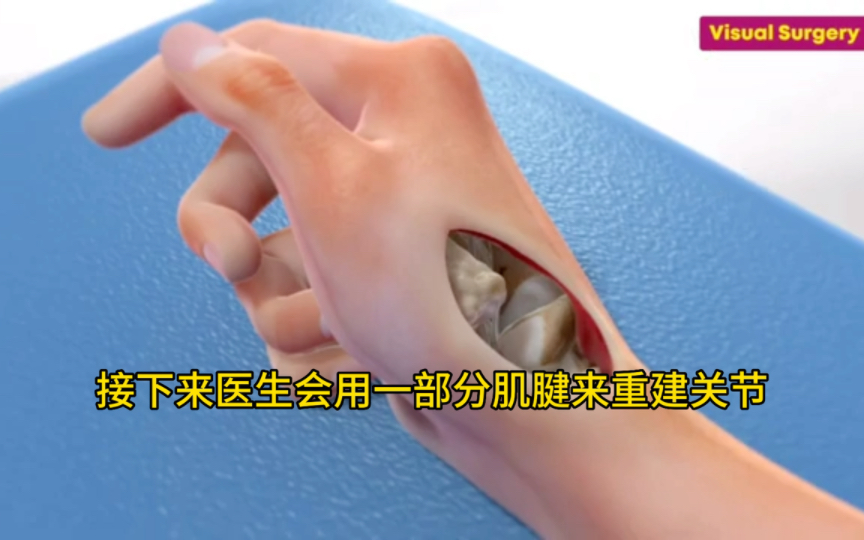 拇指骨关节炎手术治疗动画演示，看着都疼！