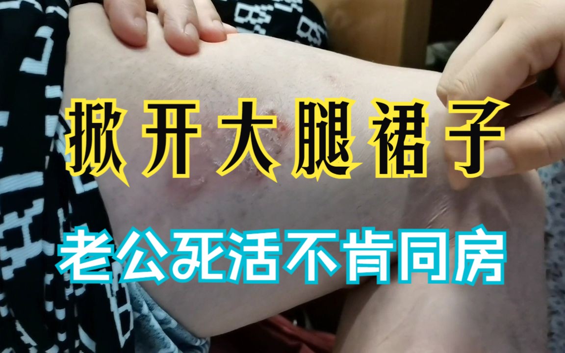 女子掀开大腿裙子，老公死活不肯同房！大夫：红彤彤的“牛皮癣“