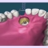 埋伏牙拔除矫正丨长沙牙齿矫正