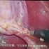 胆囊切除手术 标准手术视频
