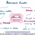 Aphthous ulcers