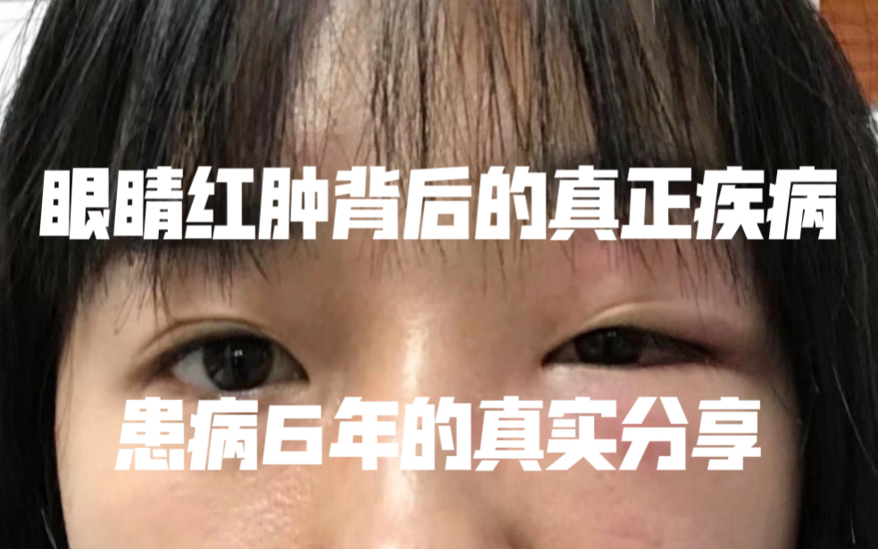 皮肌炎的症状