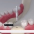 口腔科医生是怎么为患者种植牙的呢