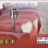 你知道：种植牙手术全过程
