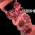 结肠癌的手术治疗过程，3D演示。。