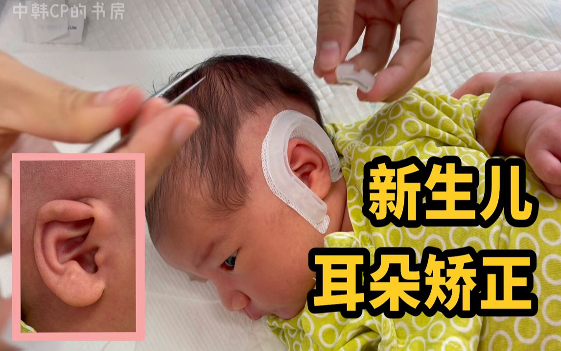 宝宝耳朵这样，带矫正器能有效果吗？