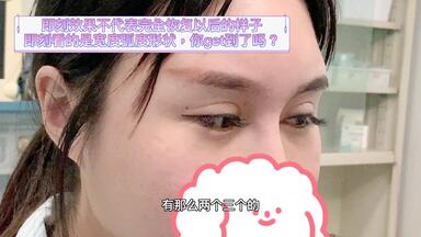 <em class="keyword">双眼皮修复宽</em>降窄恢复期风险（中）