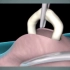 3D医学动画：输精管结扎术