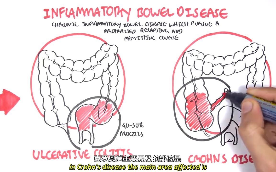 克罗恩病＆溃疡性结肠炎 | Crohn ＆ Ulcerative Colitis