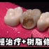 惊人的牙医重建被龋齿损坏的牙齿，高清牙髓治疗+树脂