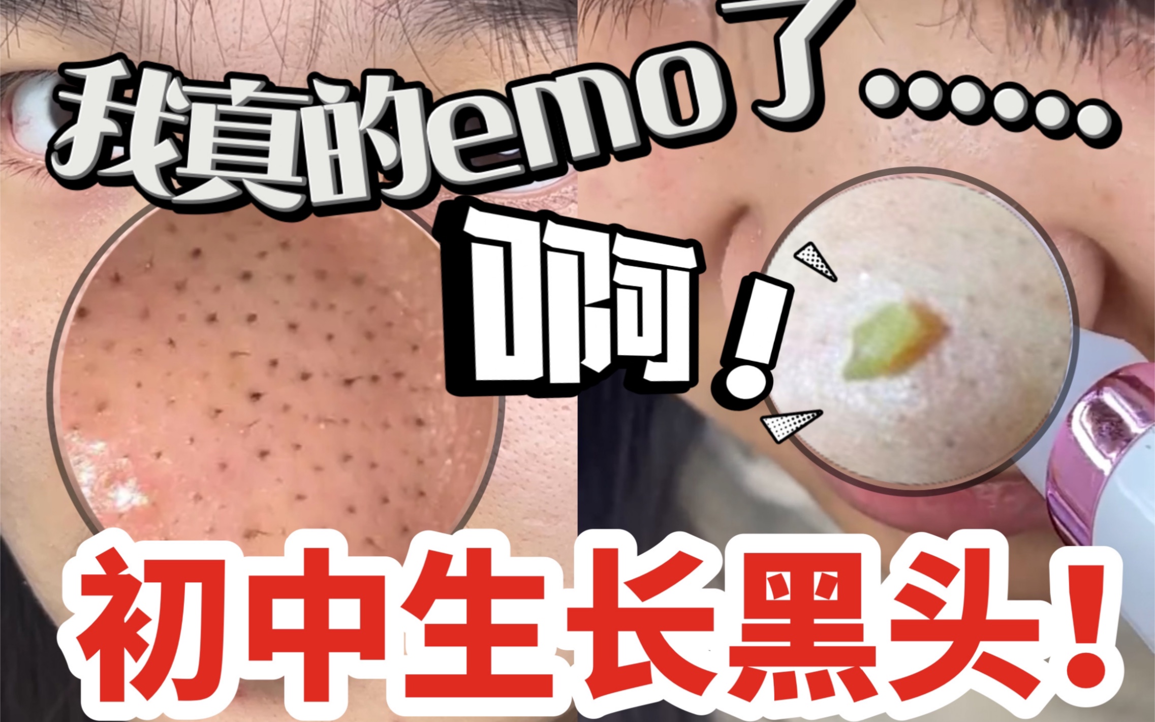 【去黑头方法】初中生长黑头！变丑！手把手教你怎么治黑头！小气泡清除草莓鼻！