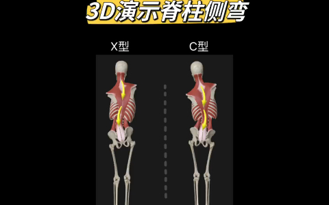 3D演示脊柱侧弯｜解剖学分析一目了然
