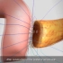 乔布斯的手术，胰腺空肠吻合术，3D演示。。