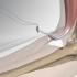 肱二头肌远端肌腱断裂的手术修复，3D演示。。