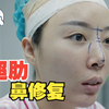 舒铂超肋鼻修复