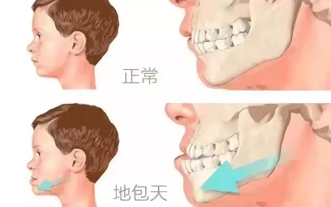 济宁壹颗芽口腔牙齿矫正儿童地包天的危害有哪些?哔哩哔哩bilibili