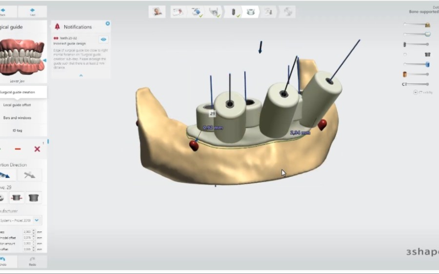 3shape下颌无牙颌种植导板设计教程